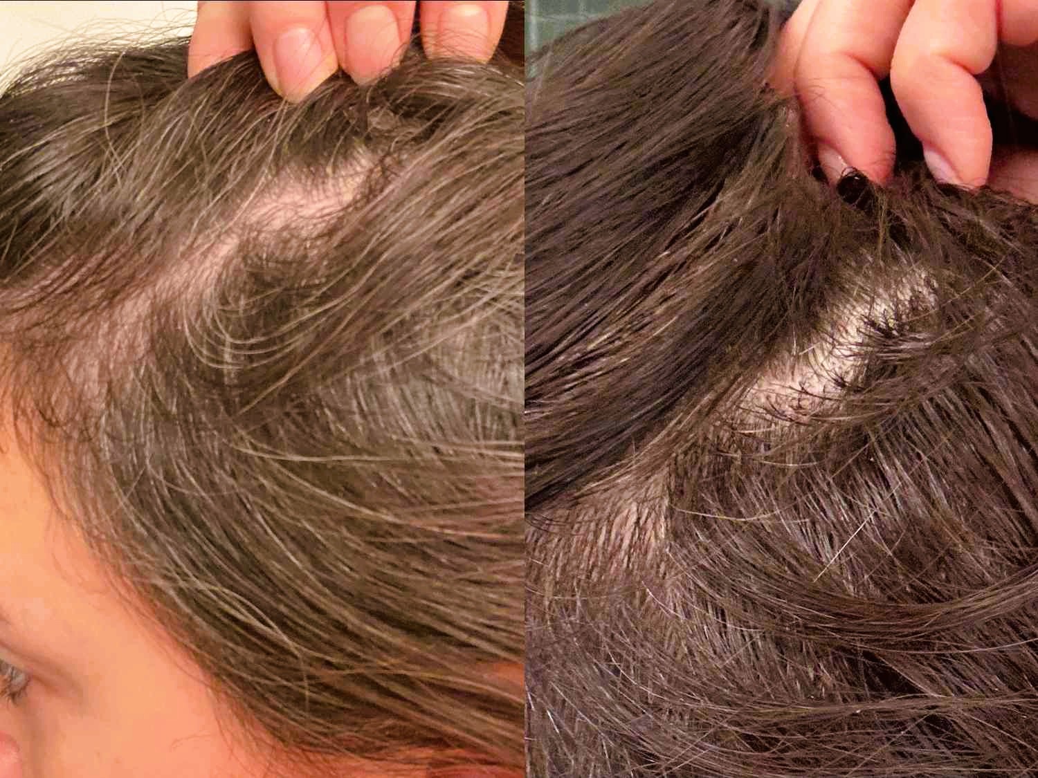 Hair Loss Treatments Hair Loss Treatments